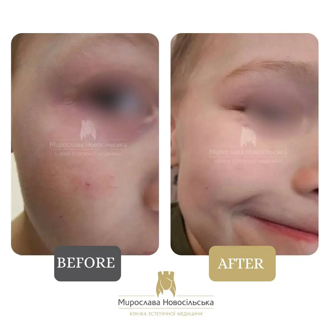 Laser removal of vascular meshes and stars, photo 3