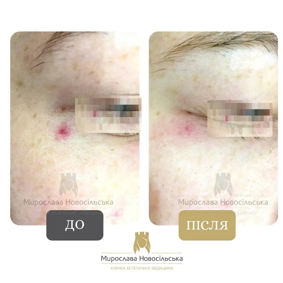 Лазерне видалення судинних сіточок та зірочок, фото 4