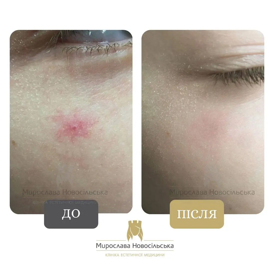 Лазерне видалення судин, фото 11