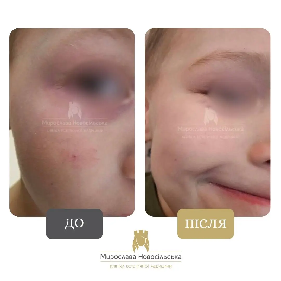 Лазерне видалення судин, фото 12