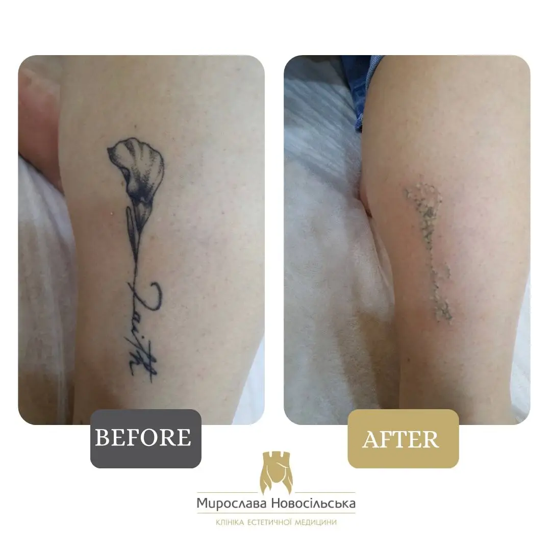 Laser tattoo removal, photo 2