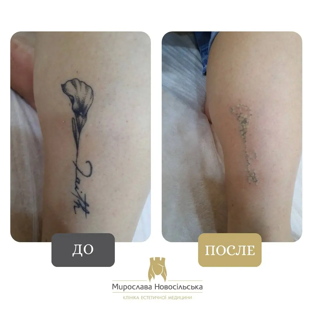 Лазерное удаление тату, фото 2
