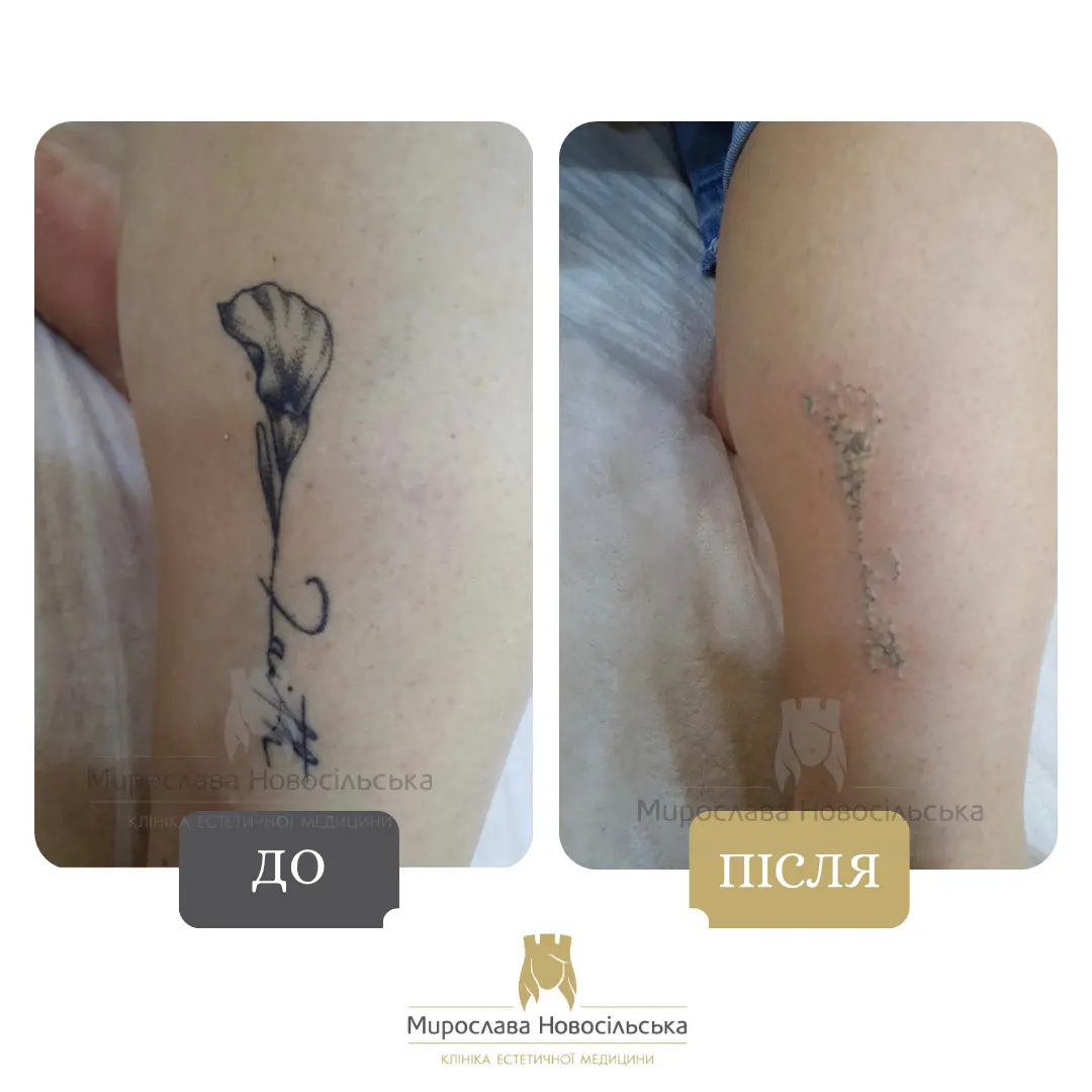 Лазерне видалення тату, фото 2