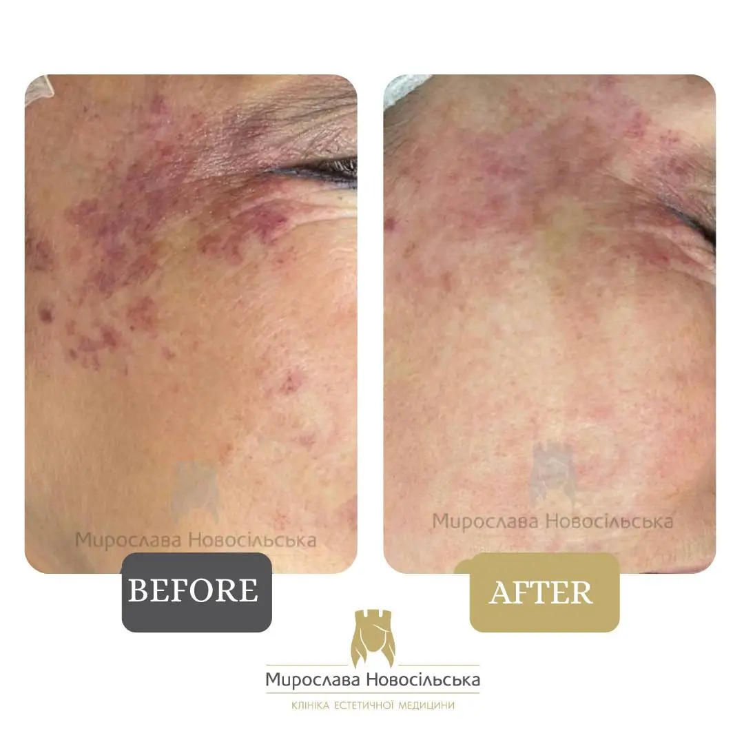 Laser removal of port-wine stains, photo 2