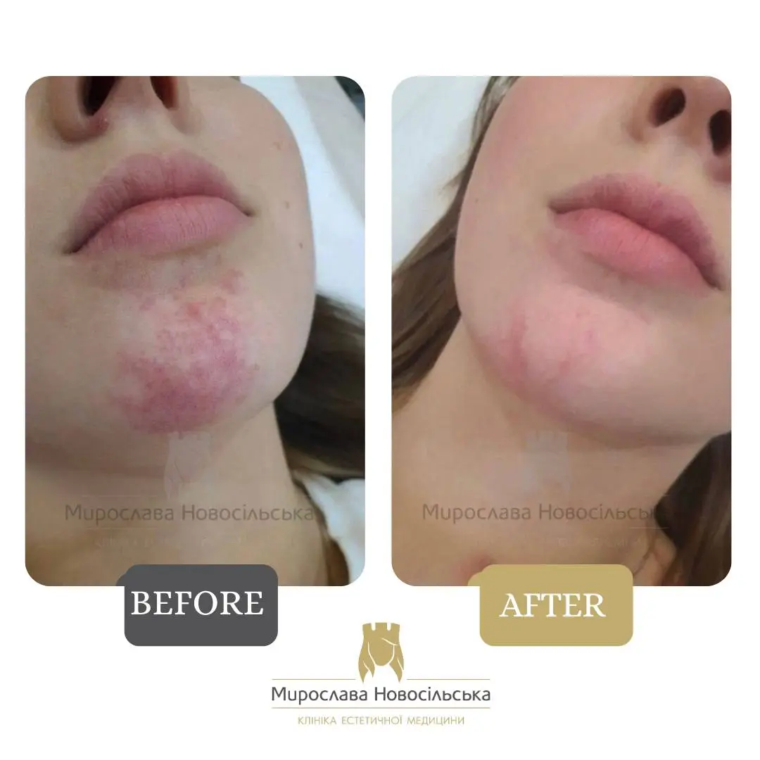 Laser removal of port-wine stains
