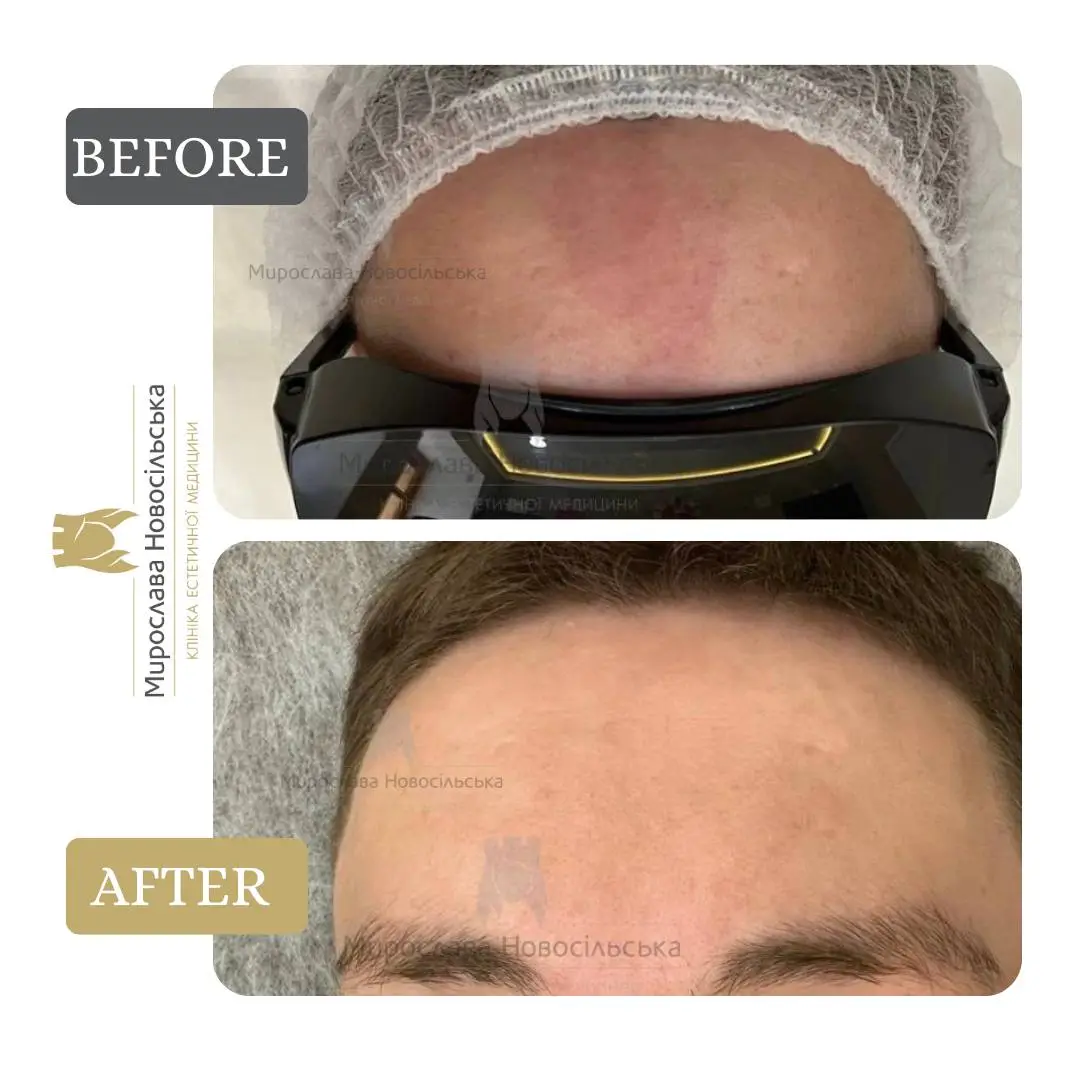 Laser removal of port-wine stains