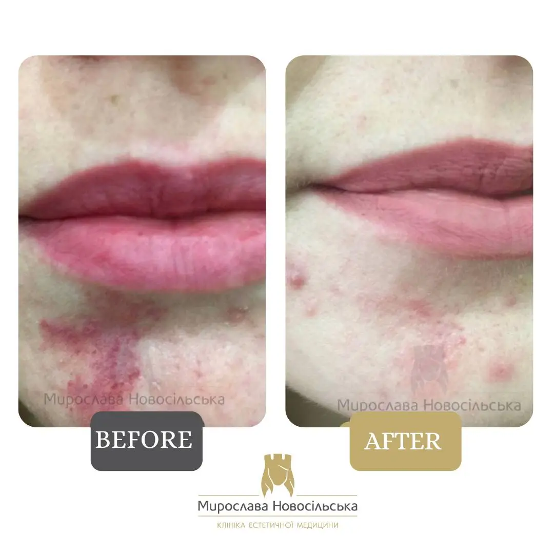 Laser removal of port-wine stains