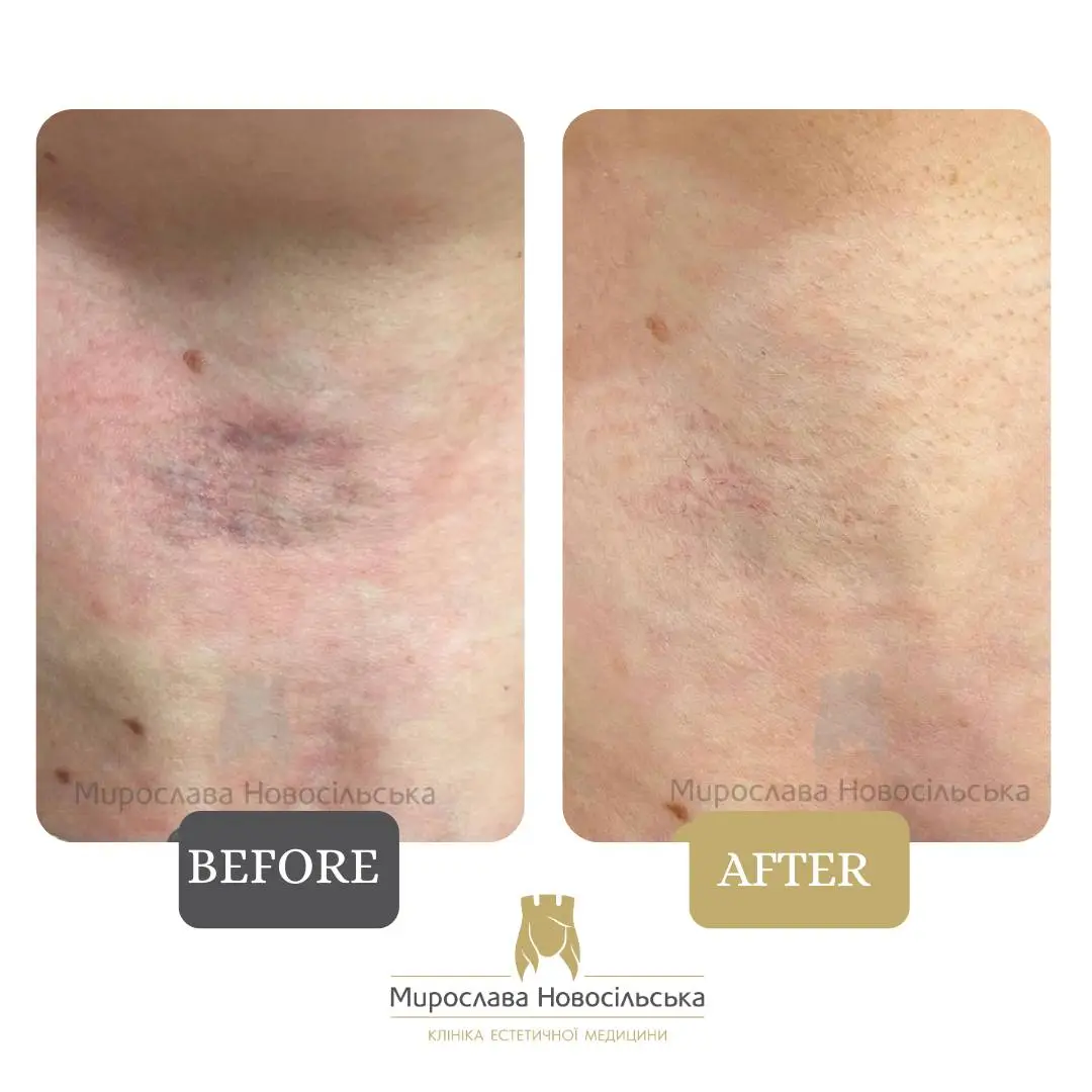 Laser removal of port-wine stains, photo 6