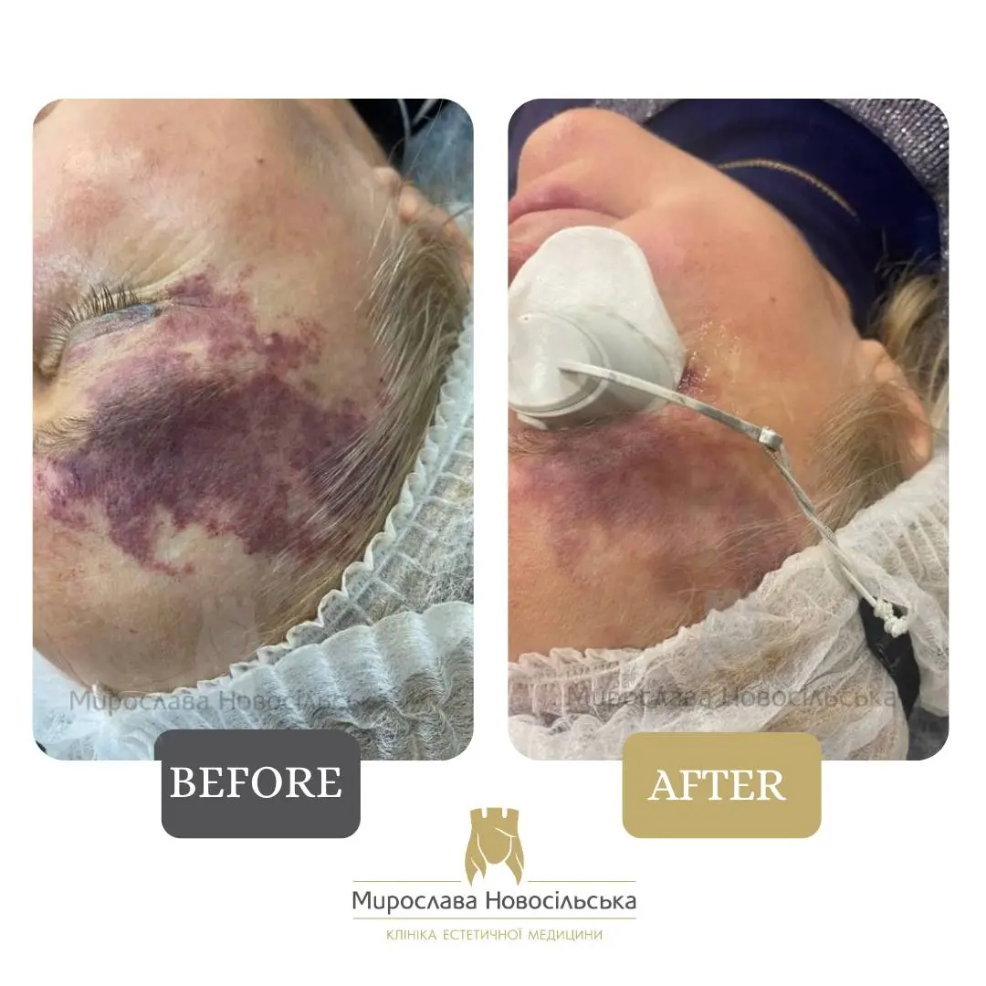 Laser removal of port-wine stains, photo 7