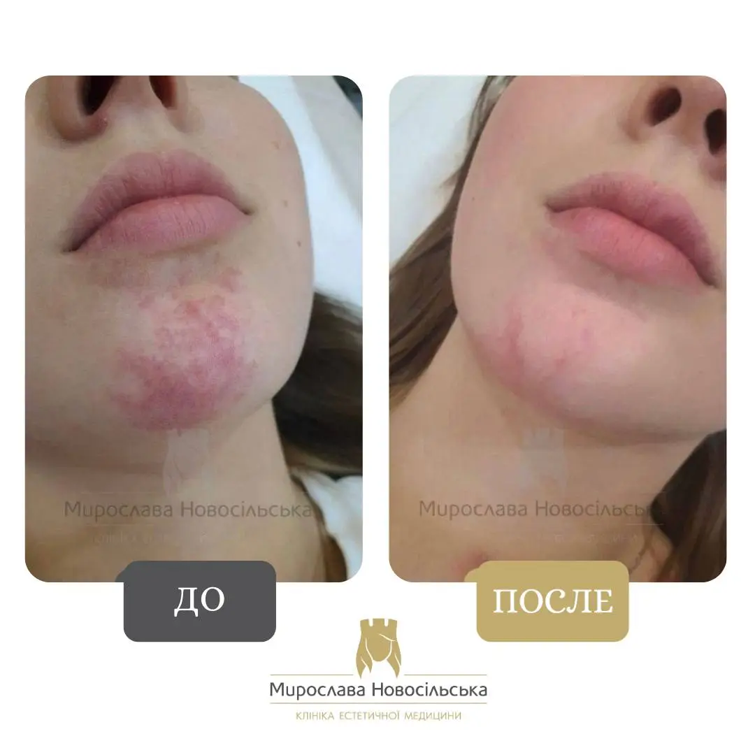 Лазерное удаление винных пятен, фото 3