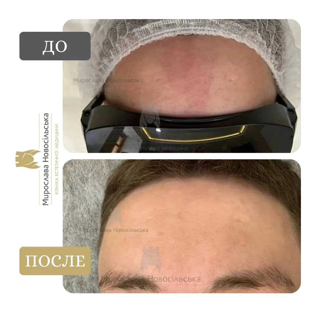 Лазерное удаление винных пятен, фото 4