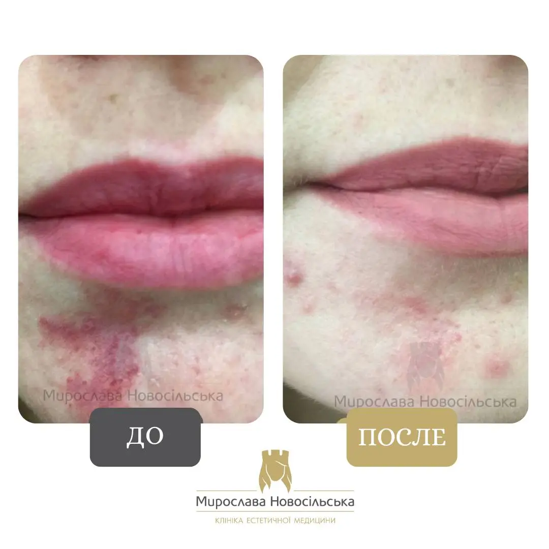 Лазерное удаление винных пятен, фото 5