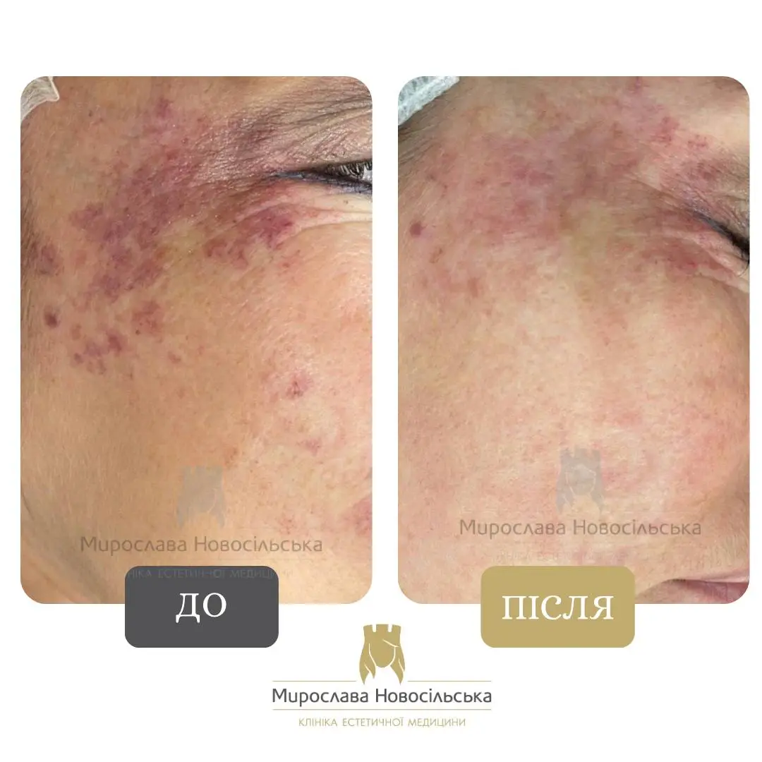 Лазерне видалення винних плям, фото 2