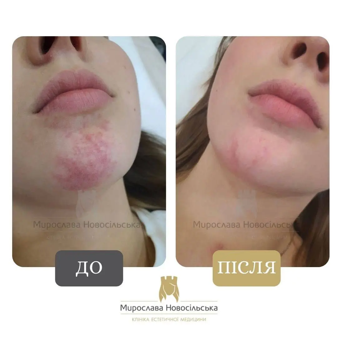 Лазерне видалення винних плям, фото 3