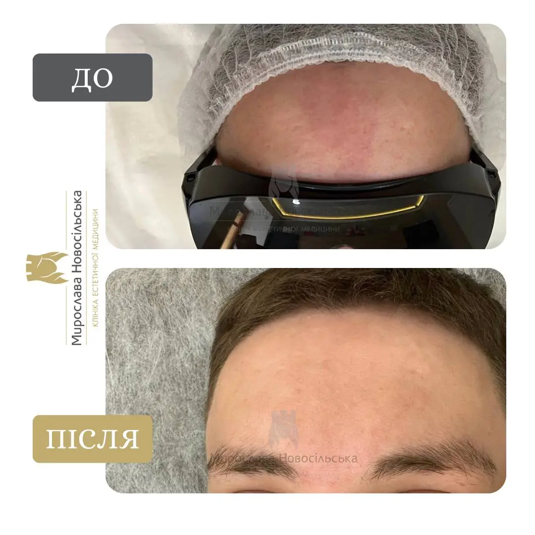 Лазерне видалення винних плям, фото 4