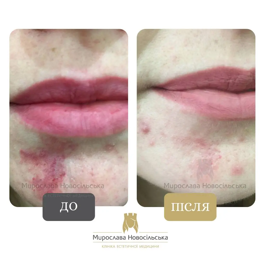 Лазерне видалення винних плям, фото 5