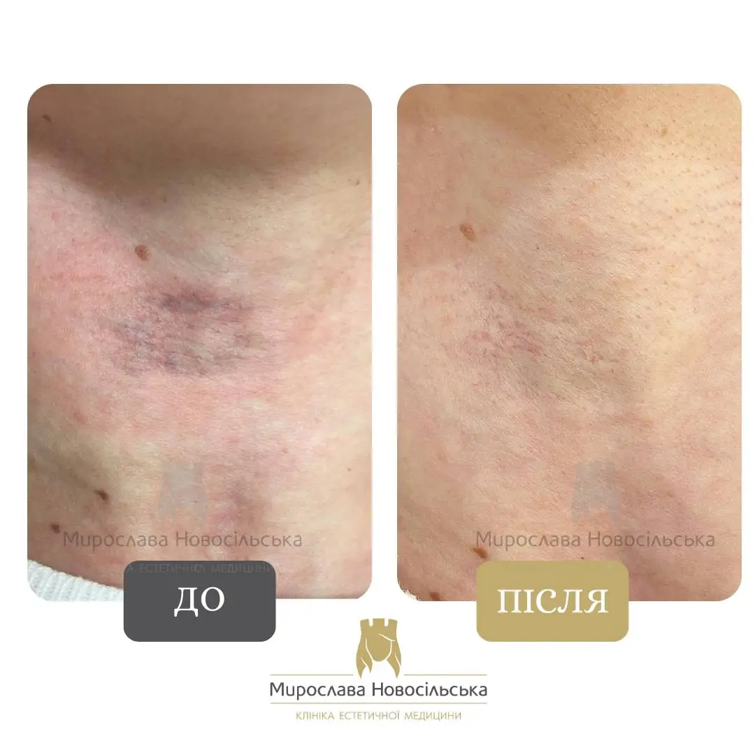 Лазерне видалення винних плям, фото 6