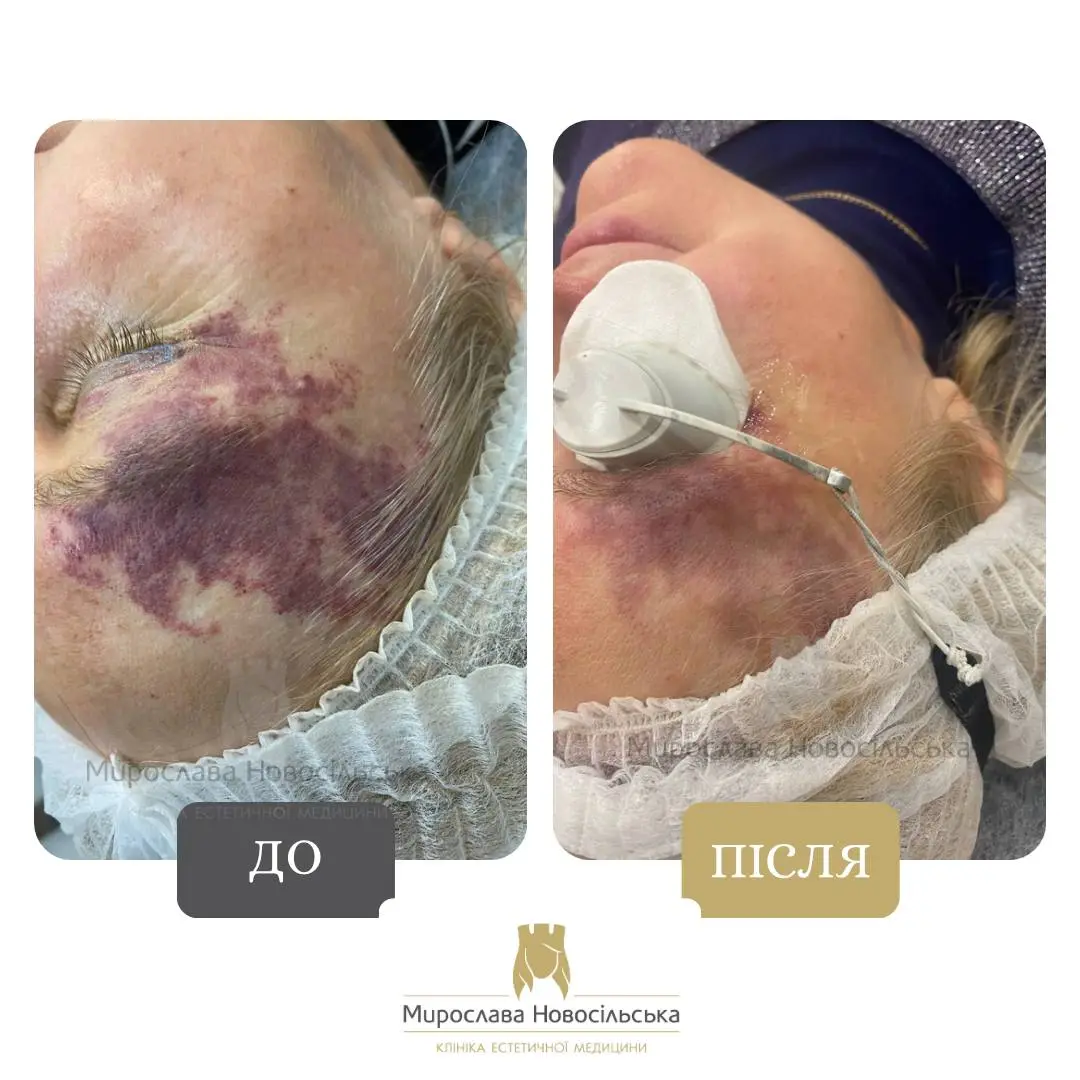 Лазерне видалення винних плям, фото 7