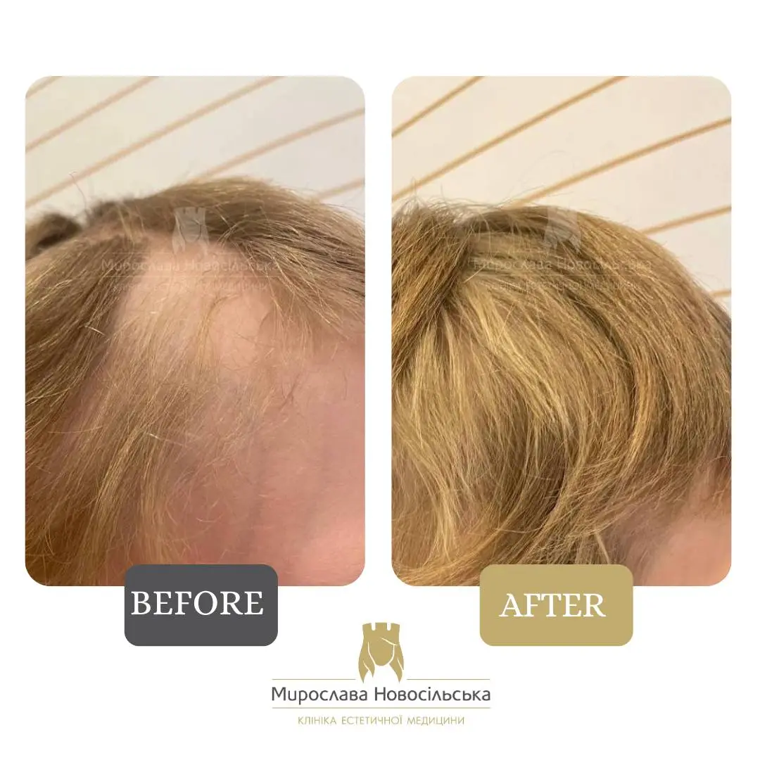 Treatment of alopecia, photo 3