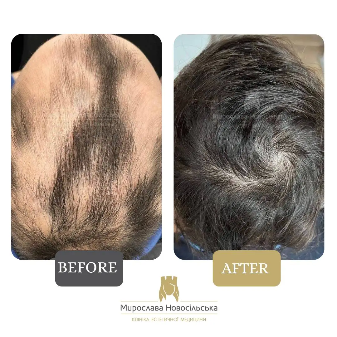 Treatment of alopecia, photo 2