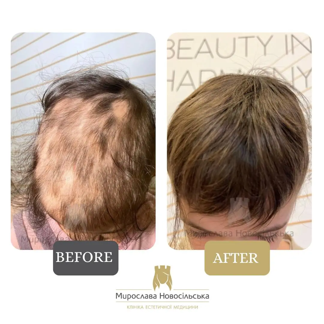 Treatment of alopecia, photo 4