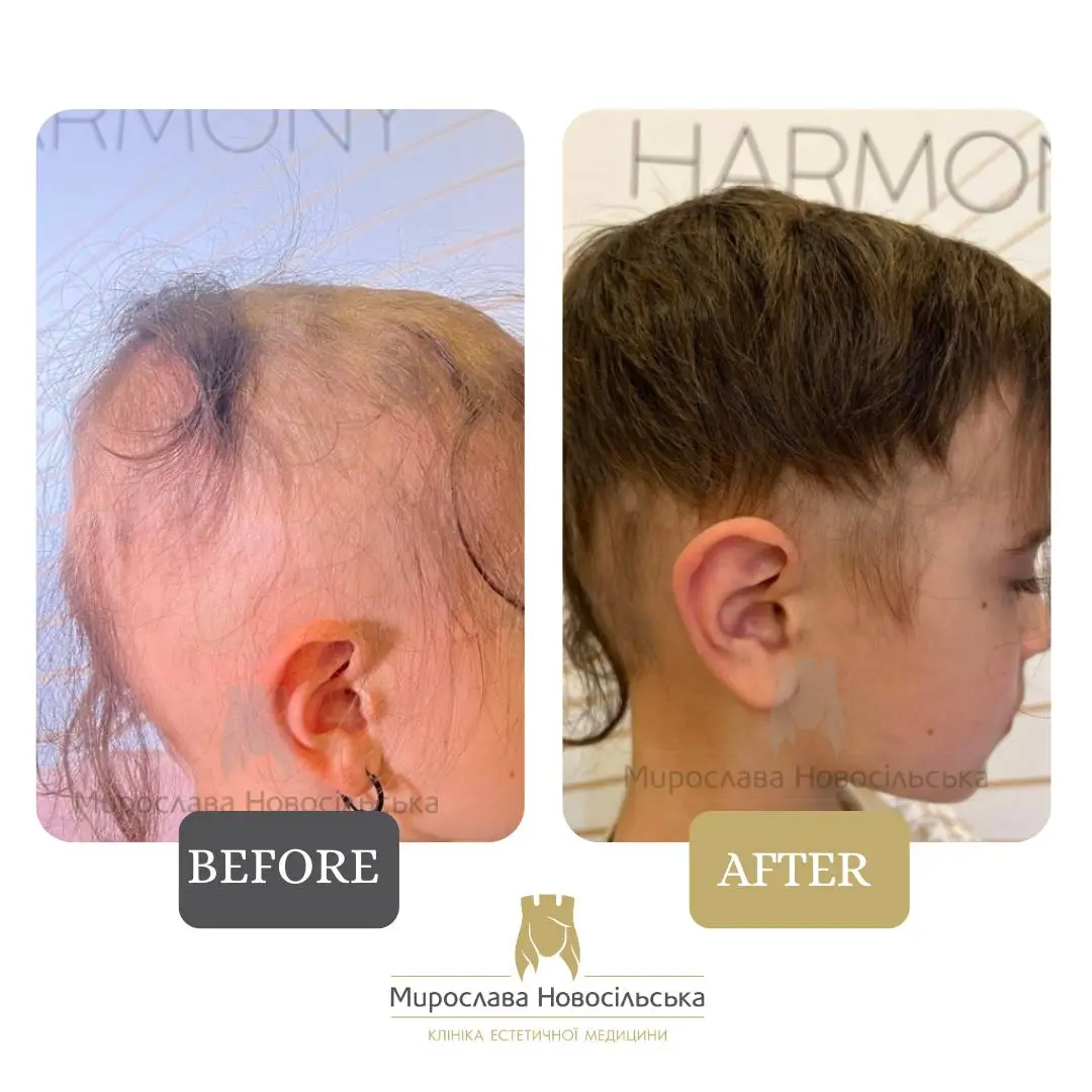Treatment of alopecia, photo 5