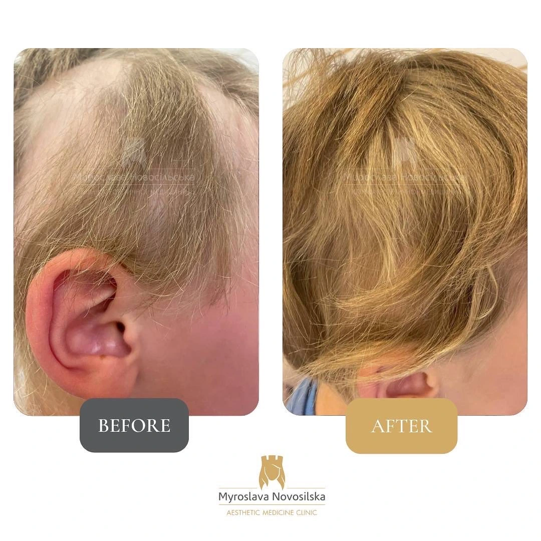 Treatment of alopecia, photo 6