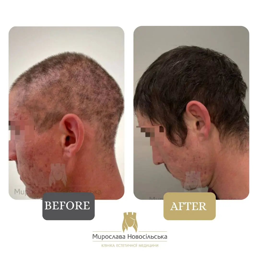 Treatment of alopecia, photo 23