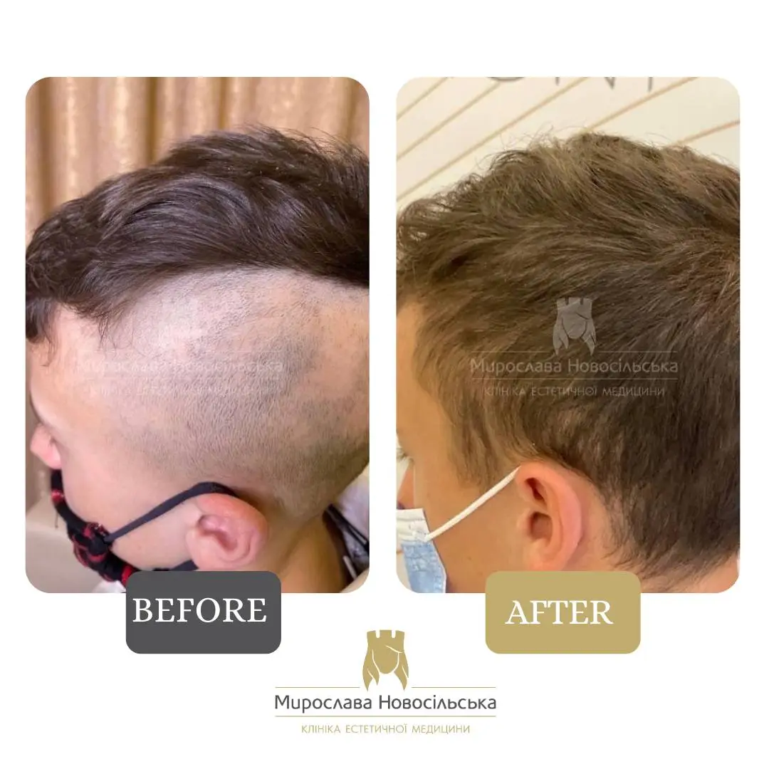 Treatment of alopecia in men