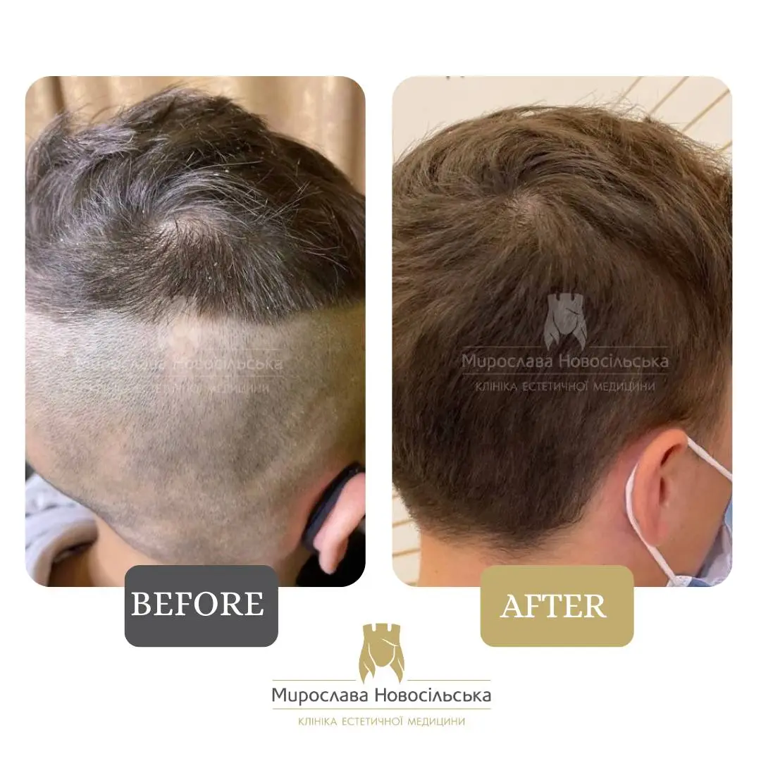 Treatment of alopecia, photo 21