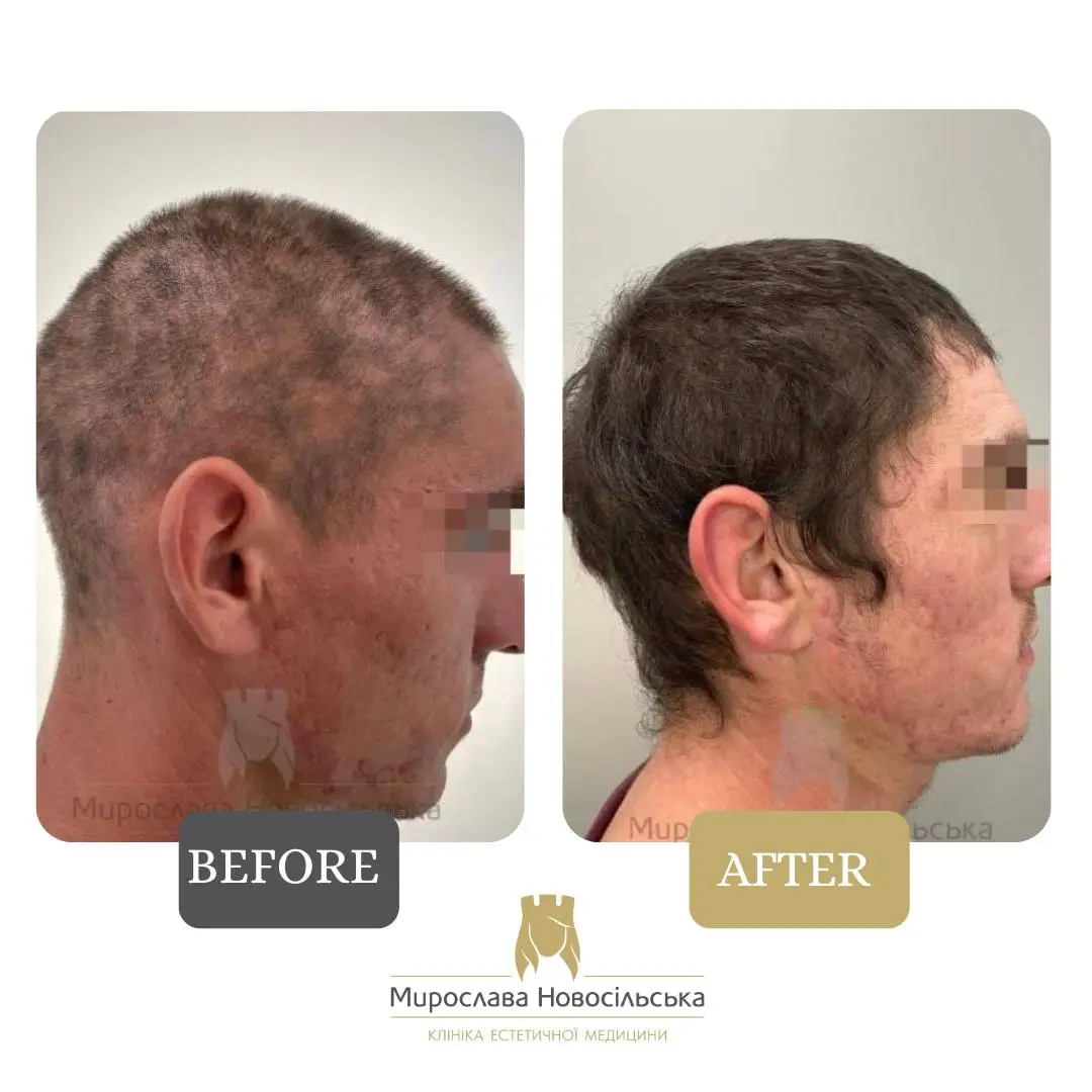 Treatment of alopecia, photo 20