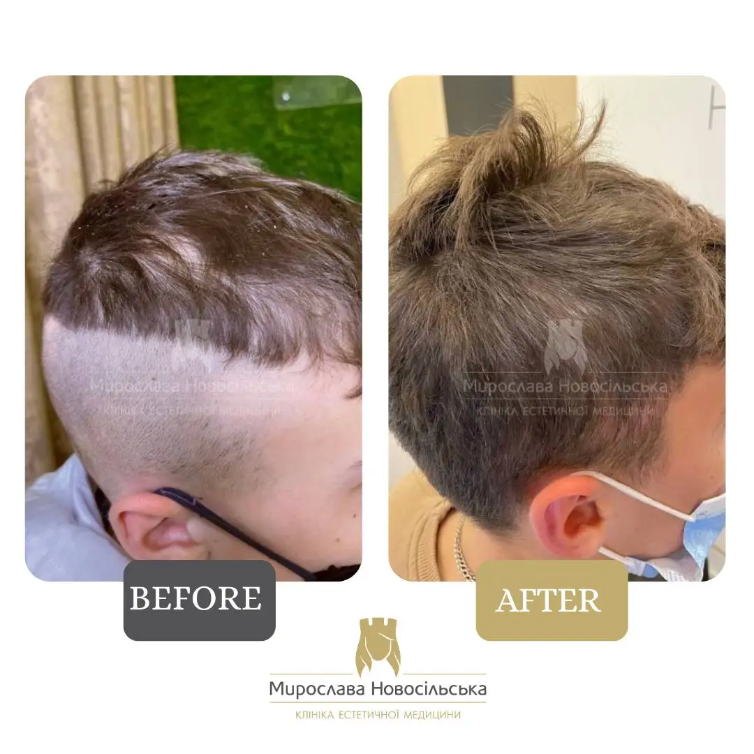 Treatment of alopecia in men