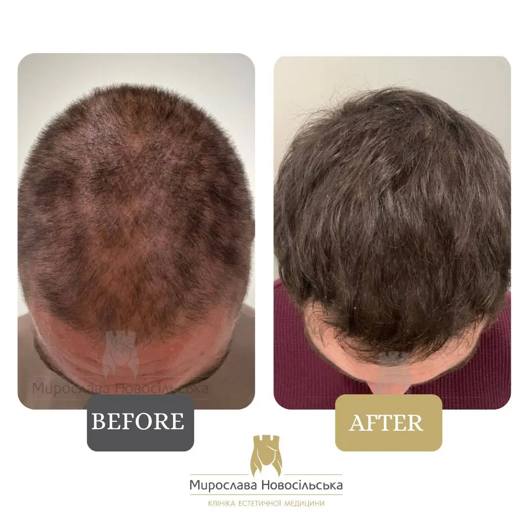 Treatment of alopecia in men