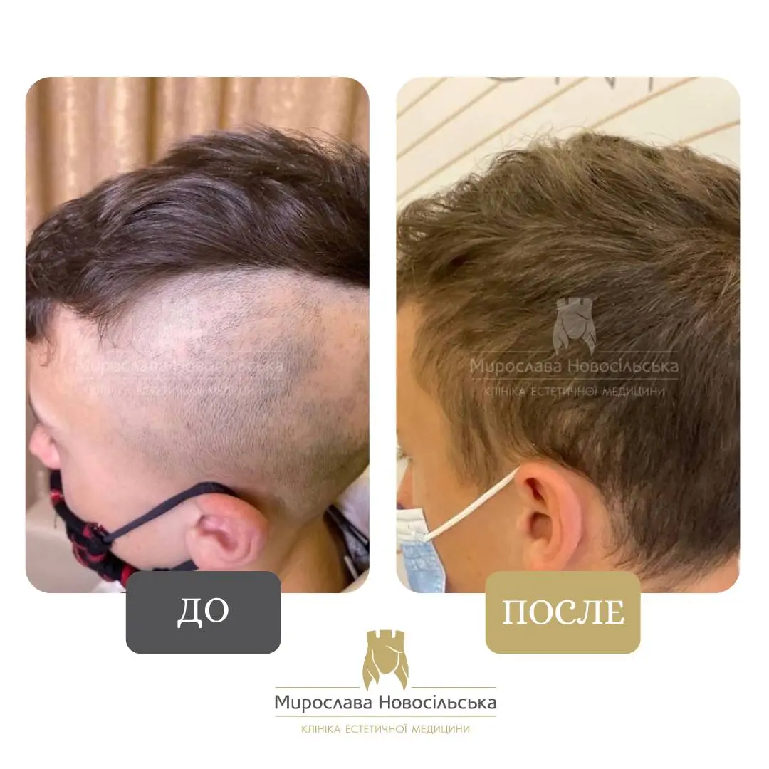 Лечение алопеции у мужчин, фото 6