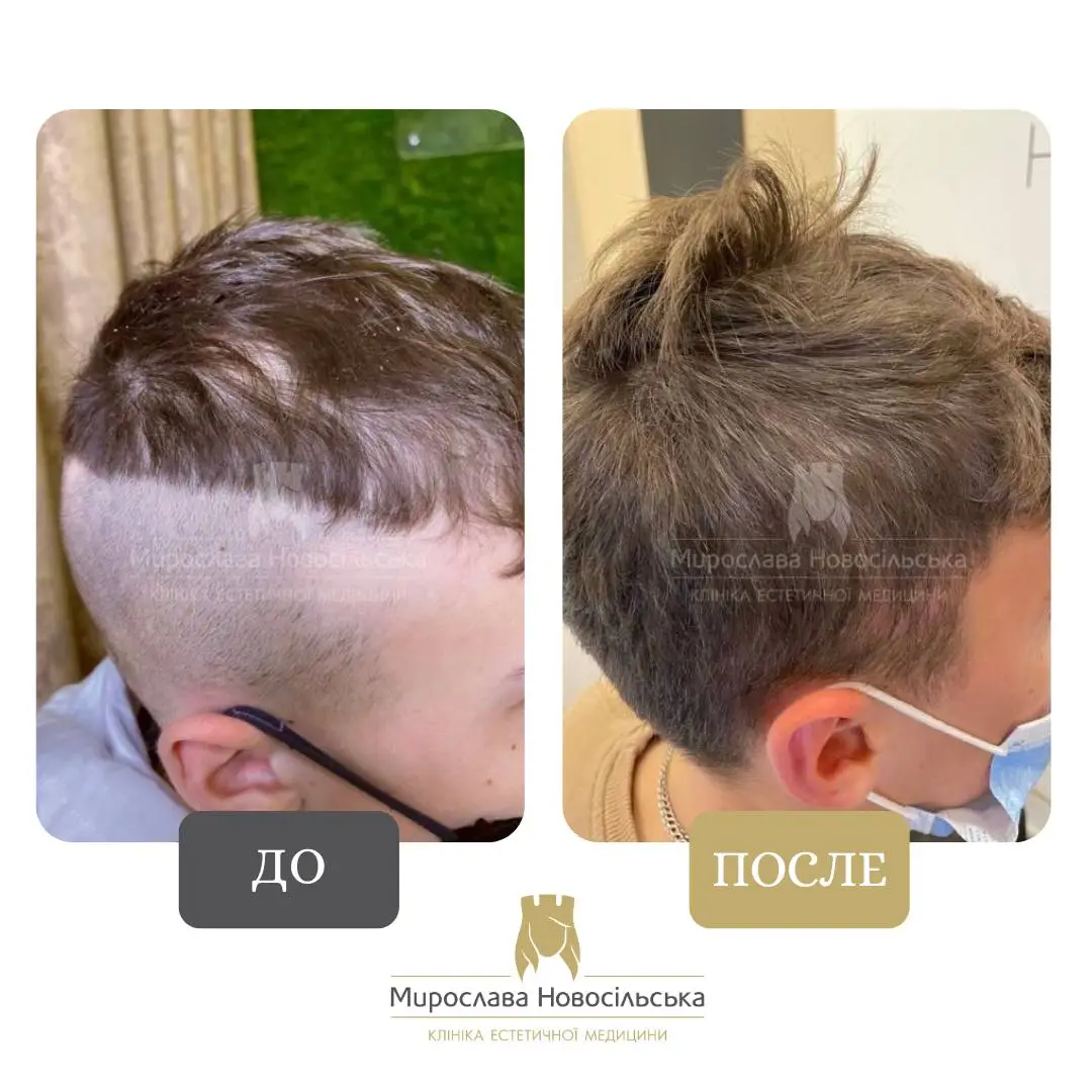 Лечение алопеции у мужчин, фото 3