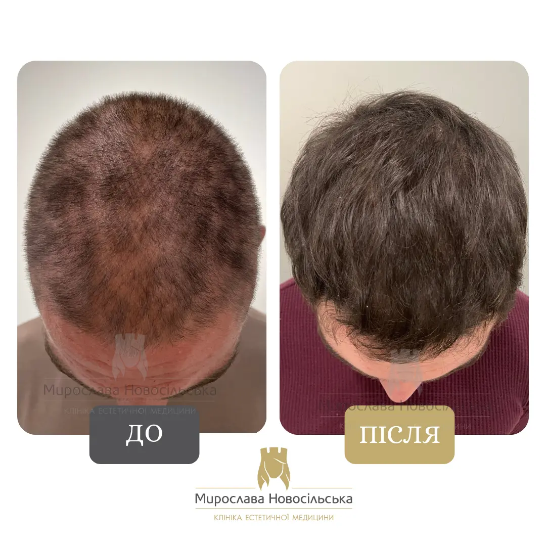 Лікування алопеції, фото 18