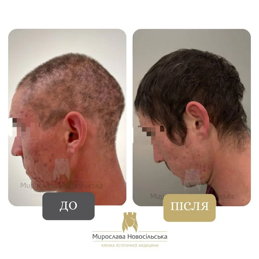 Лікування алопеції, фото 23