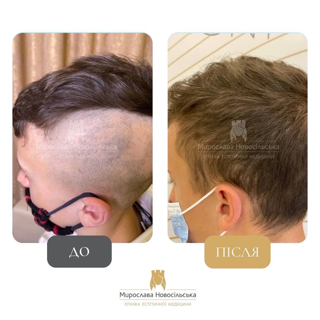 Лікування алопеції, фото 22