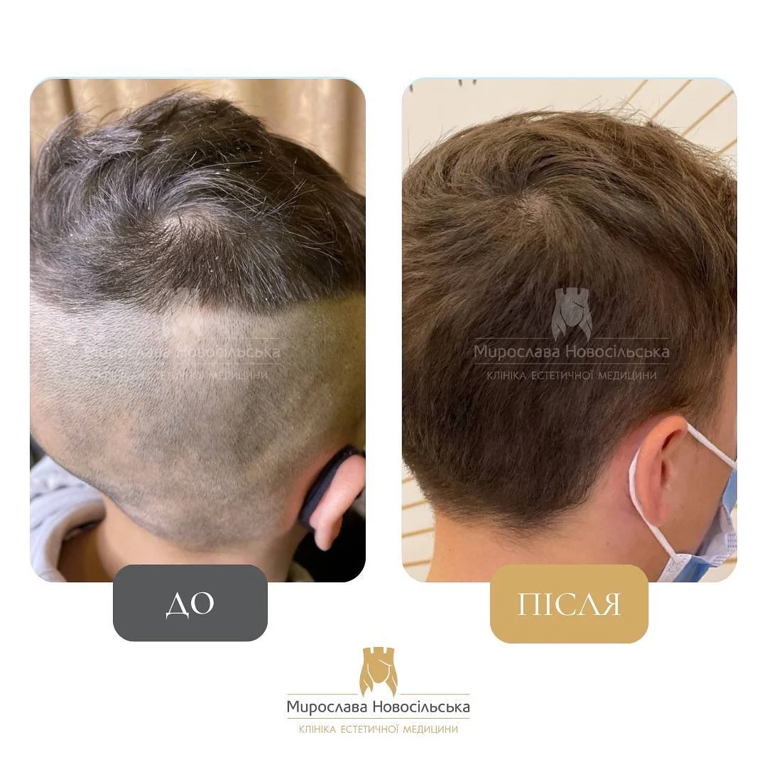 Лікування алопеції, фото 21