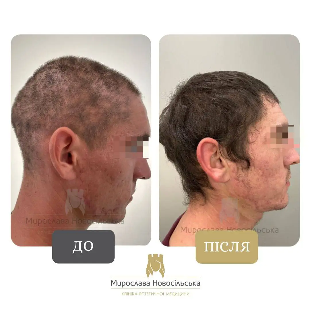 Лікування алопеції, фото 20