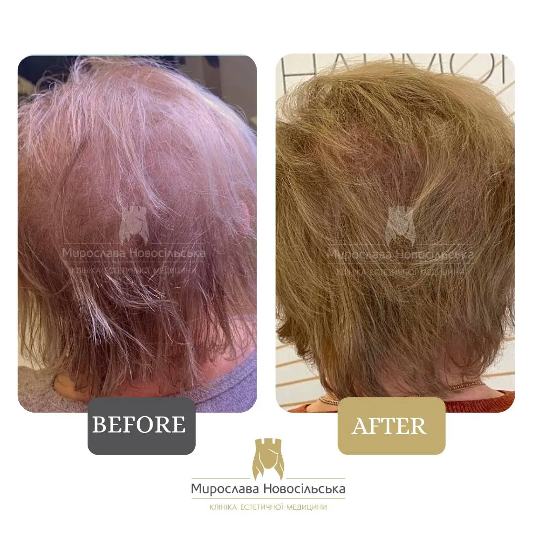 Treatment of alopecia in women, photo 12