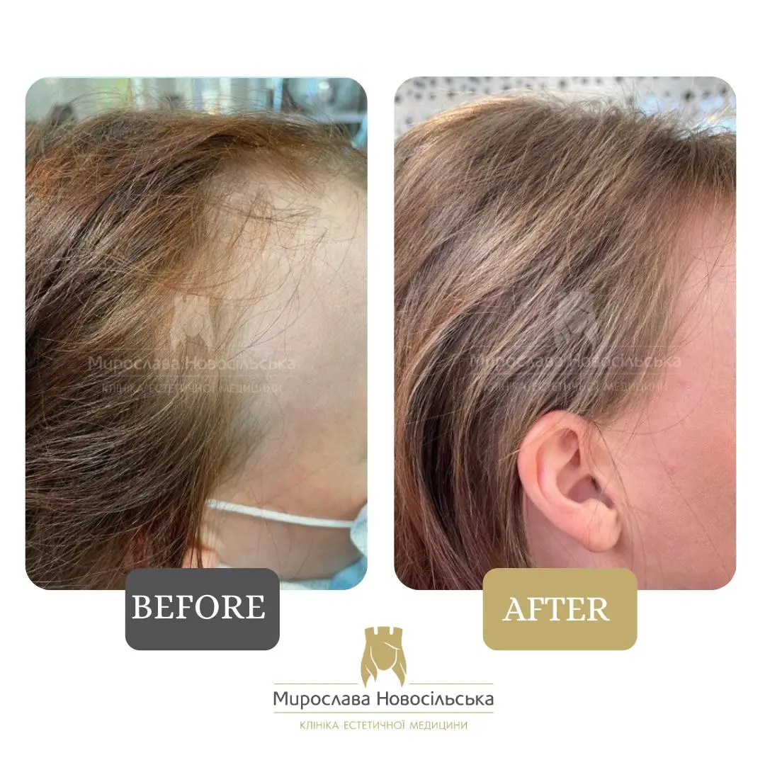 Treatment of alopecia in women