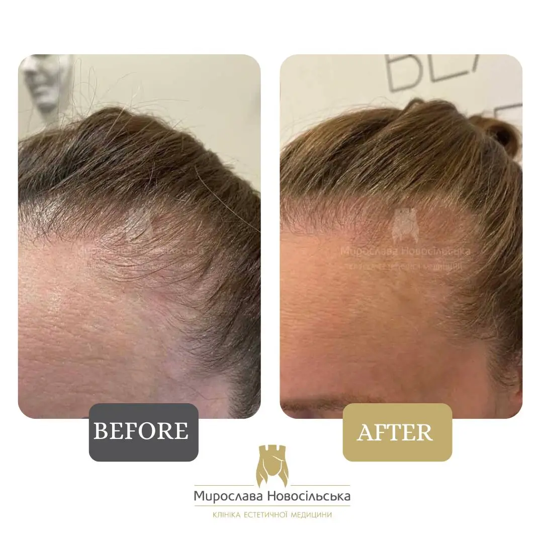 Treatment of alopecia in women, photo 2