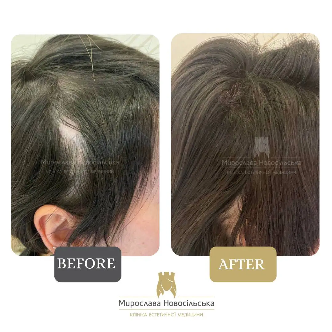Treatment of alopecia in women, photo 10