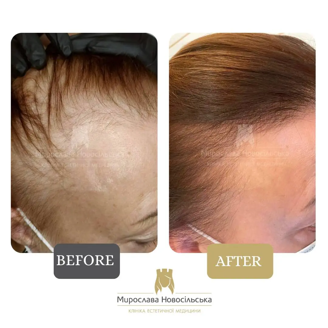 Treatment of alopecia