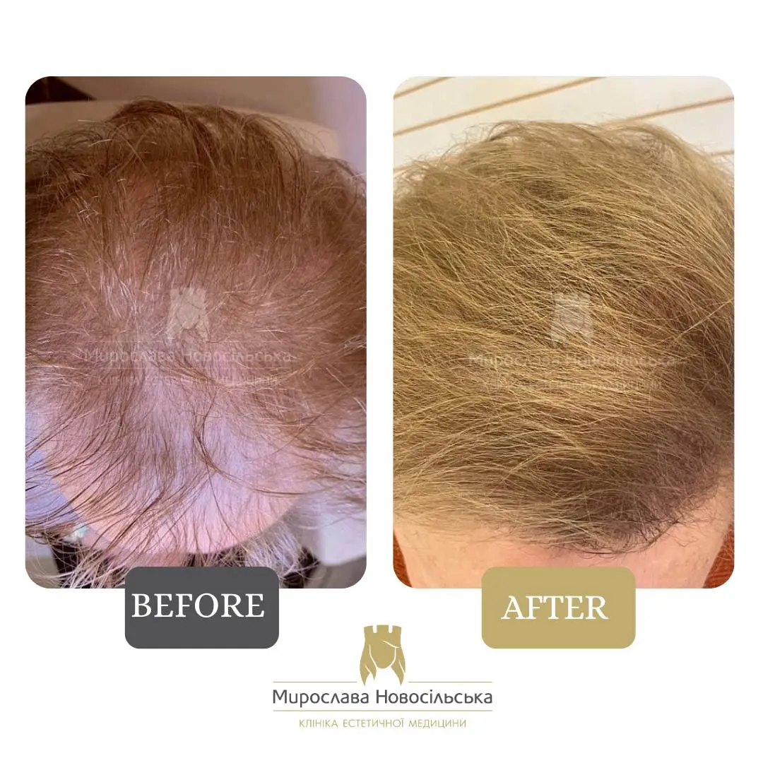 Treatment of alopecia in women, photo 9