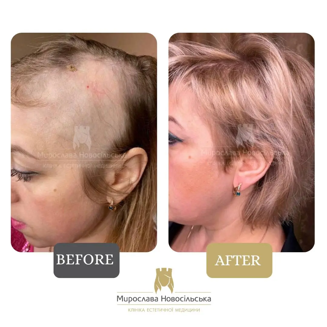 Treatment of alopecia in women, photo 8