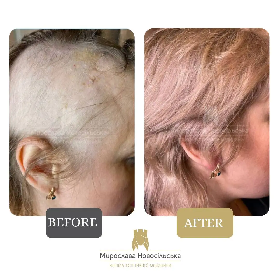 Treatment of alopecia in women, photo 7
