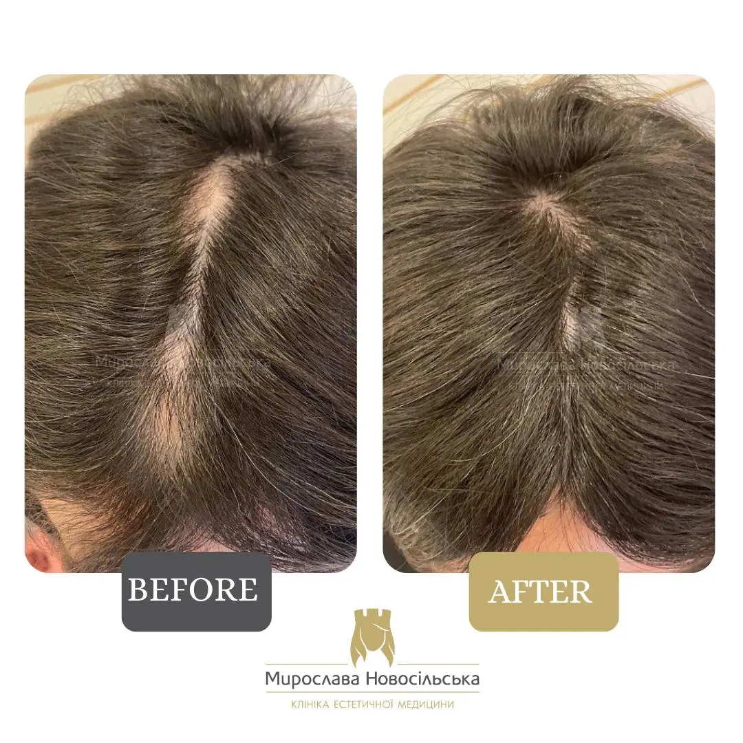 Treatment of alopecia in women, photo 5