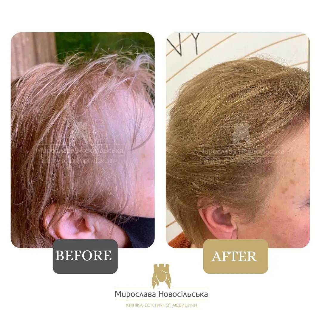 Treatment of alopecia in women, photo 4